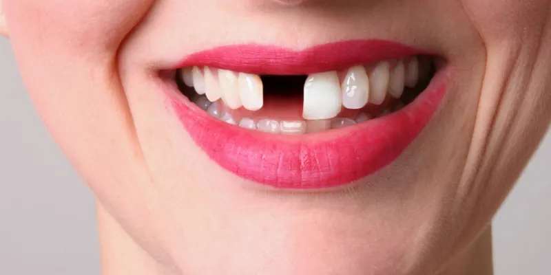 Nằm mơ rụng răng có thể là dấu hiệu mất đi sự tự tin